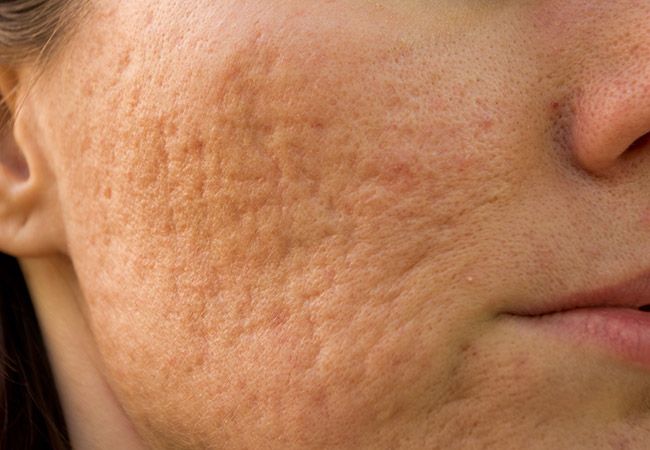 Chemical Peels for Acne Scars: How They Work and What to Expect
